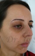 Septoplasty - Photo before - Dr. med. Jozefina Skulavik