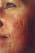 Microdermabrasion - Photo before - Klinika Laser Esthetic