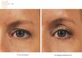 Ultherapy - Photo before - Dr n. med. Marcin Bieńkowski