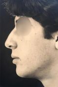Rhinoplastie - Cliché avant - Docteur Pierre Laur