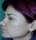 Fotorejuvenecimiento (IPL) - rejuvenecimiento de la piel - Foto Antes de - Dr. Aristides Arellano-Huacuja