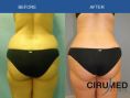 Liposucción - Foto Antes de - Cirumed Clinic