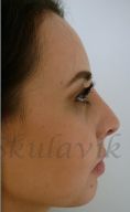 Septoplasty - Photo before - Dr. med. Jozefina Skulavik