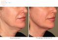 Ultherapy - Photo before - Dr n. med. Marcin Bieńkowski