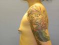 Breast Augmentation - Breast Implants - Photo before - Adam J. Rubinstein M.D., FACS