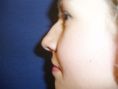 Rhinoplasty (Nose Job) - Photo before - Klinika Laser Esthetic