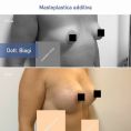 Mastoplastica additiva - Foto del prima - Dott. Cristiano Biagi