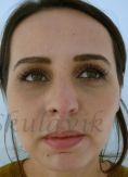 Septoplasty - Photo before - Dr. med. Jozefina Skulavik