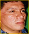 Fotorejuvenecimiento (IPL) - rejuvenecimiento de la piel - Foto Antes de - Dr. Aristides Arellano-Huacuja