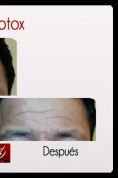 Botox/Dysport - Eliminar arrugas - Foto Antes de - Dr. Aristides Arellano-Huacuja