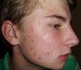 Laser acne treatment - Photo before - Klinika Laser Esthetic