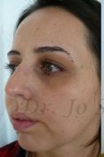 Septoplasty - Photo before - Dr. med. Jozefina Skulavik