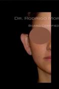 Ear surgery (Otoplasty) - Photo before - Dr. Rodrigo Morales De la Cerda