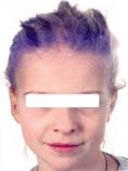 Ear surgery (Otoplasty) - Photo before - Klinika Laser Esthetic
