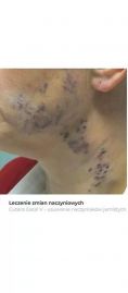 Spider veins laser removal (redness, birh marks) - Photo before - Bieńkowscy Clinic®