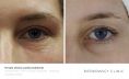 Non Surgical Lift - Photo before - Bieńkowscy Clinic®