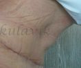 Abdominoplasty (Tummy Tucks) - Photo before - Dr. med. Jozefina Skulavik