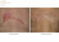Laser Scar Treatment - Photo before - Dr n. med. Marcin Bieńkowski