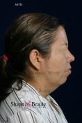 Liposucción - Foto Antes de - Dr. Marco Antonio Carmona M.D.