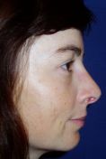 Rhinoplasty (Nose Job) - Photo before - Klinika Laser Esthetic