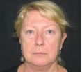 Facelift - Photo before - Dr. Michael Zacharia
