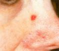Spider veins laser removal (redness, birh marks) - Photo before - Klinika Laser Esthetic