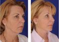 Rhinoplasty (Nose Job) - Photo before - Michel Siegel MD