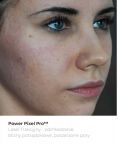 Fractional Laser Resurfacing - Photo before - Bieńkowscy Clinic®