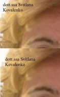 Filler - Foto del prima - Dott.ssa Svitlana Kovalenko