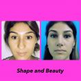 Reducción de mamas - femenina de 24 años con nariz punta bullosa , se realiza rinoplastia cerrada sexto mes posoperatorio