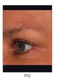 Radiofrequenz-Rejuvenation - Vorher Foto - MUDr. Martin Molitor PhD.