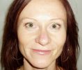 Eyelid surgery (Blepharoplasty) - Photo before - Klinika Laser Esthetic