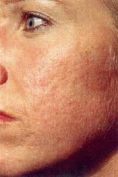 Microdermabrasion - Photo before - Klinika Laser Esthetic