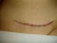 Scar removal - Photo before - Klinika Laser Esthetic