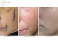 Laser Scar Treatment - Photo before - Dr n. med. Marcin Bieńkowski
