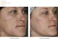 Laser Scar Treatment - Photo before - Dr n. med. Marcin Bieńkowski