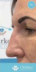 Radiesse (Calcium hydroxylapatit) - Nechirurgická metóda rhinoplastiky / korekcii nosa/ prebieha v lokálnom znecitlivení pri vedomí pacienta s pomocou kyseliny hyalurónovej.
Výplňový materiál kyselina hyalurónová sa injekčne aplikuje do oblasti nosa a koriguje vrodenú alebo získanú zmenu tvaru nosa.
Nos môže byť po aplikácií kyseliny rovnejší, súmernejší, bez jaziev po úraze.
Výsledný efekt je okamžitý.
Zákrok trvá 15 až 30 minút.
Účinok je od 6 mesiacov do 20 mesiacov.
