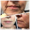 HIFU thérapie (lifting médical) - Cliché avant - Dr AMAT - ????Greffe FUE 2.0 Medic Xpert