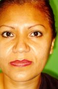 Fotorejuvenecimiento (IPL) - rejuvenecimiento de la piel - Foto Antes de - Dr. Aristides Arellano-Huacuja