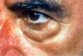 Eyelid surgery (Blepharoplasty) - Photo before - Klinika Laser Esthetic