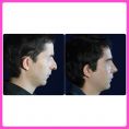 Reducción de mamas - rinoplastia rinoxifosis joven de 20 años nariz punta caida y bullosa rinoplastia cerrada 3 er mes posoperatorio