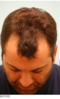 Hair Transplant - Photo before - Australian Institute of Hair Restoration