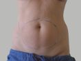 Liposukce - fotka před - OB Care
