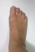 Cirugía de juanetes (hallux valgus) - Foto Antes de - Doctor Juan Carlos Albornoz