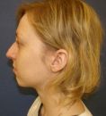 Rhinoplasty (Nose Job) - Photo before - Klinika Laser Esthetic