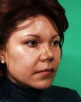 Fotorejuvenecimiento (IPL) - rejuvenecimiento de la piel - Foto Antes de - Dr. Aristides Arellano-Huacuja