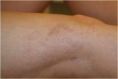Eliminare capillari e teleangectasie con laser - Foto del prima - Dr. Luigi Mazzi