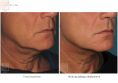 Ultherapy - Photo before - Dr n. med. Marcin Bieńkowski