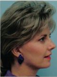 Facelift - Photo before - Wafik A Hanna