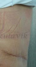 Abdominoplasty (Tummy Tucks) - Photo before - Dr. med. Jozefina Skulavik